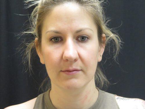 Before Image: CoolSculpting - front