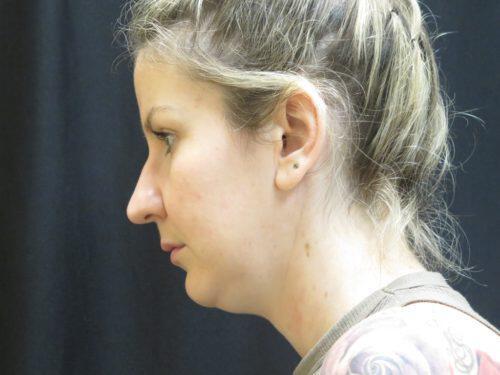 Before Image: CoolSculpting - left-side