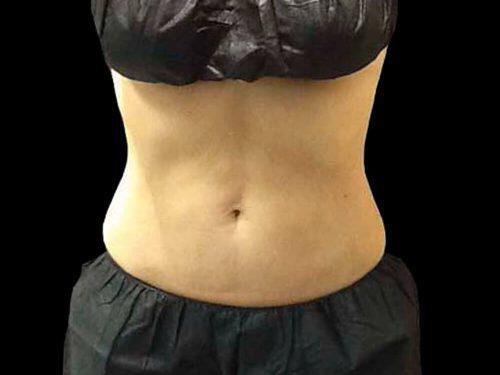 After Image: CoolSculpting - front
