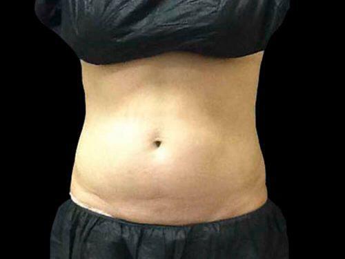 Before Image: CoolSculpting - front
