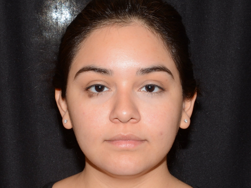 After Image: Chin Augmentation - front