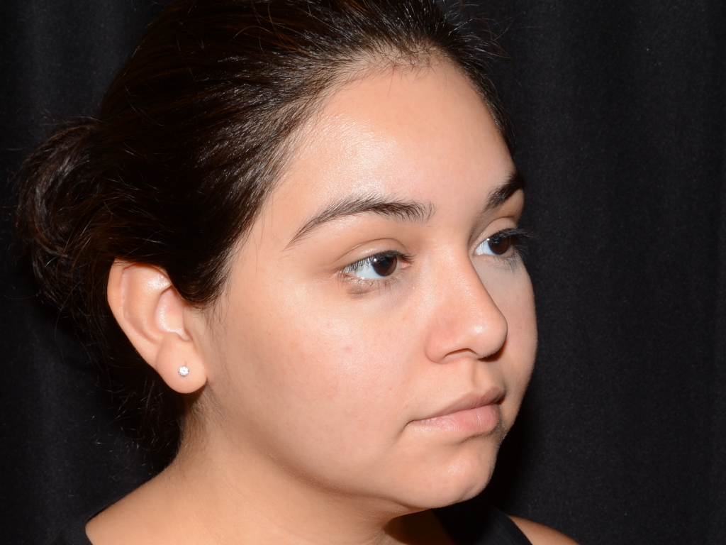 Before Image: Chin Augmentation - right-front-oblique