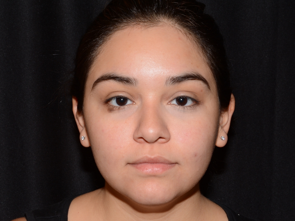 Before Image: Chin Augmentation - front