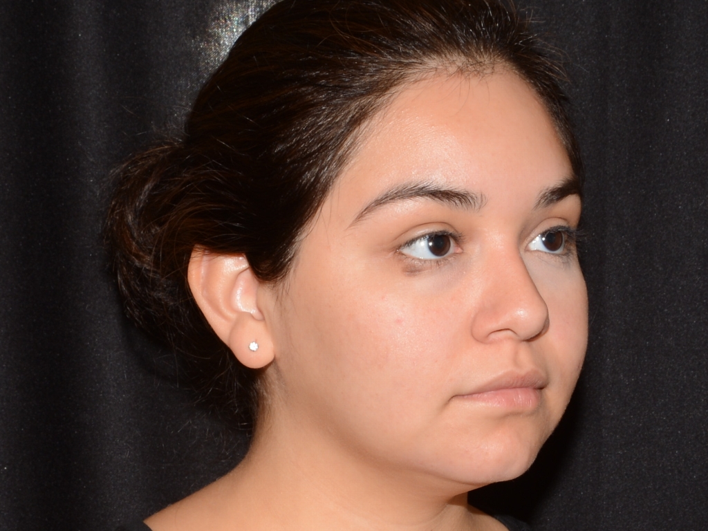After Image: Chin Augmentation - right-front-oblique