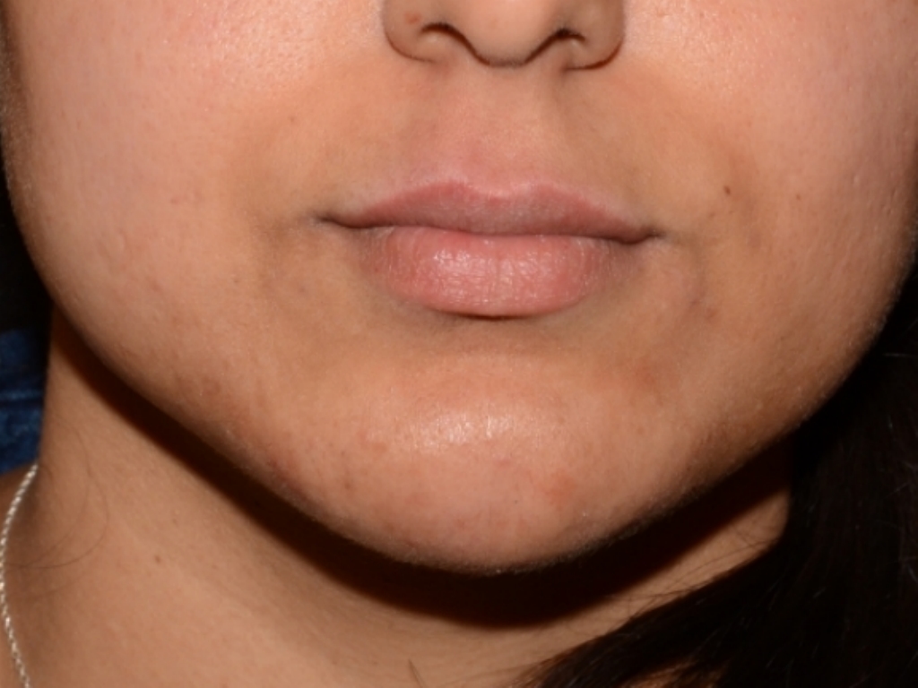 After Image: Chin Augmentation - front