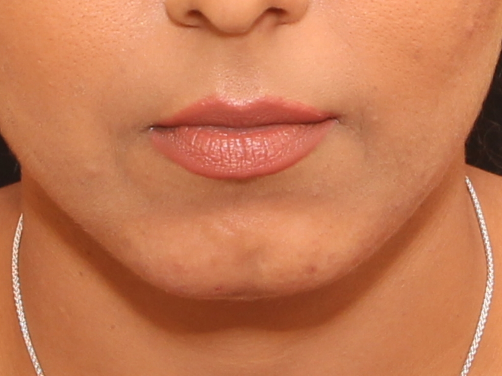 Before Image: Chin Augmentation - front