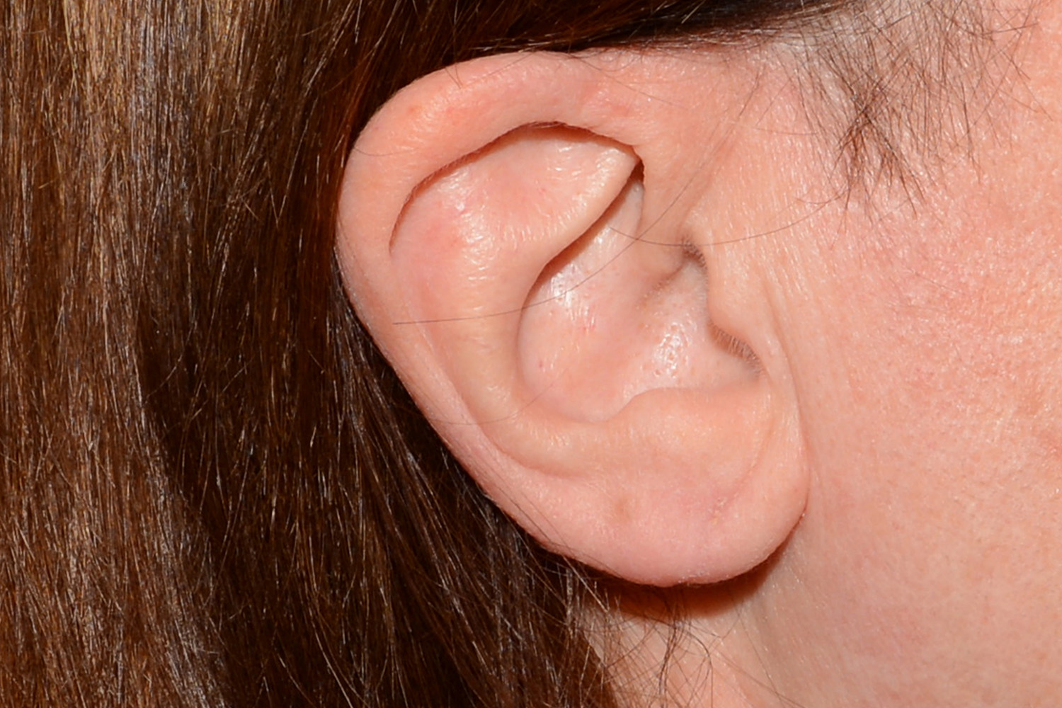 After Image: Torn Earlobe Repair - right-side