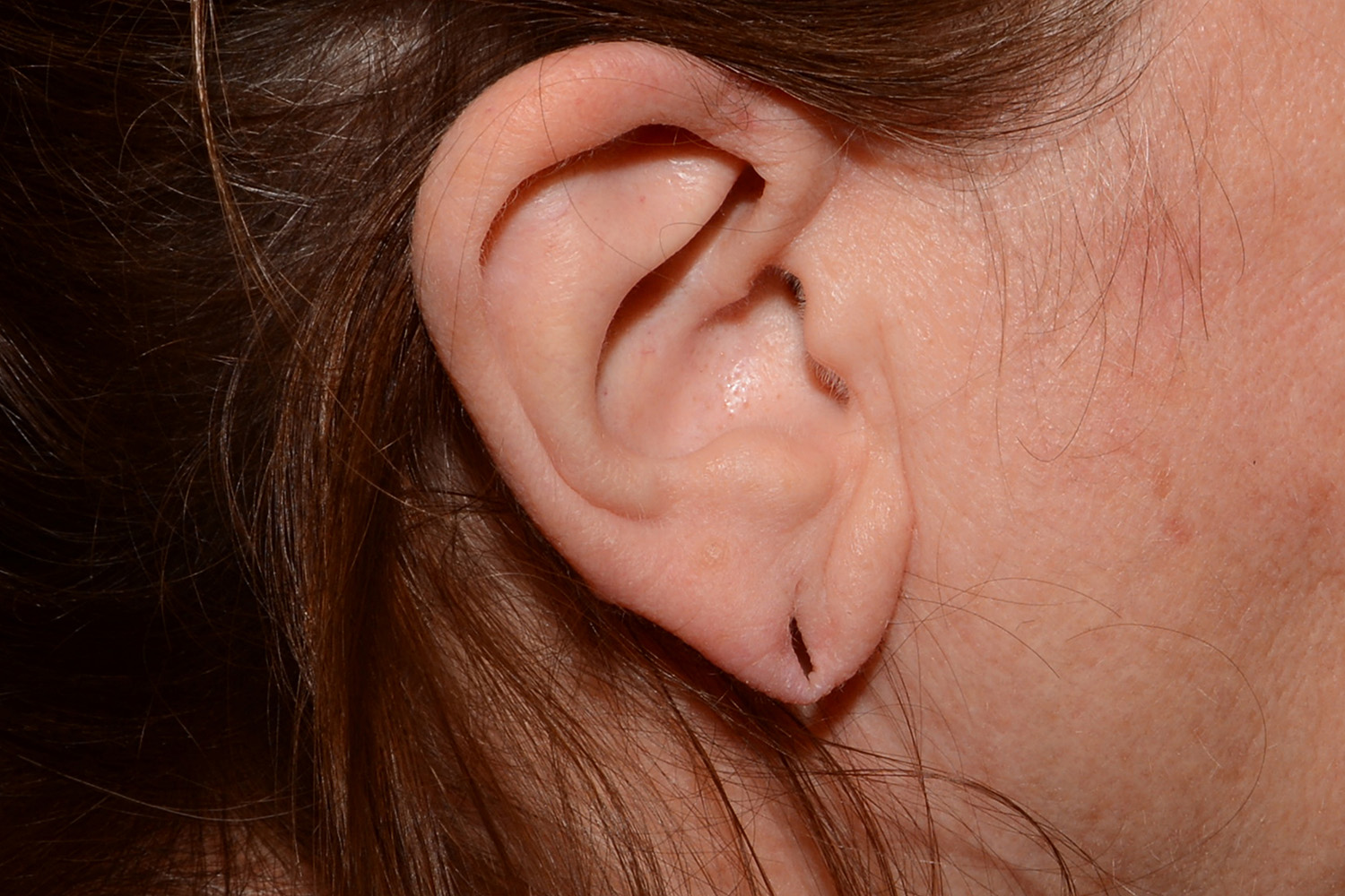Before Image: Torn Earlobe Repair - right-side