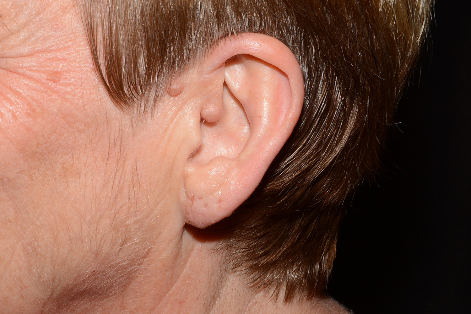 After Image: Earlobe Reduction - left-side