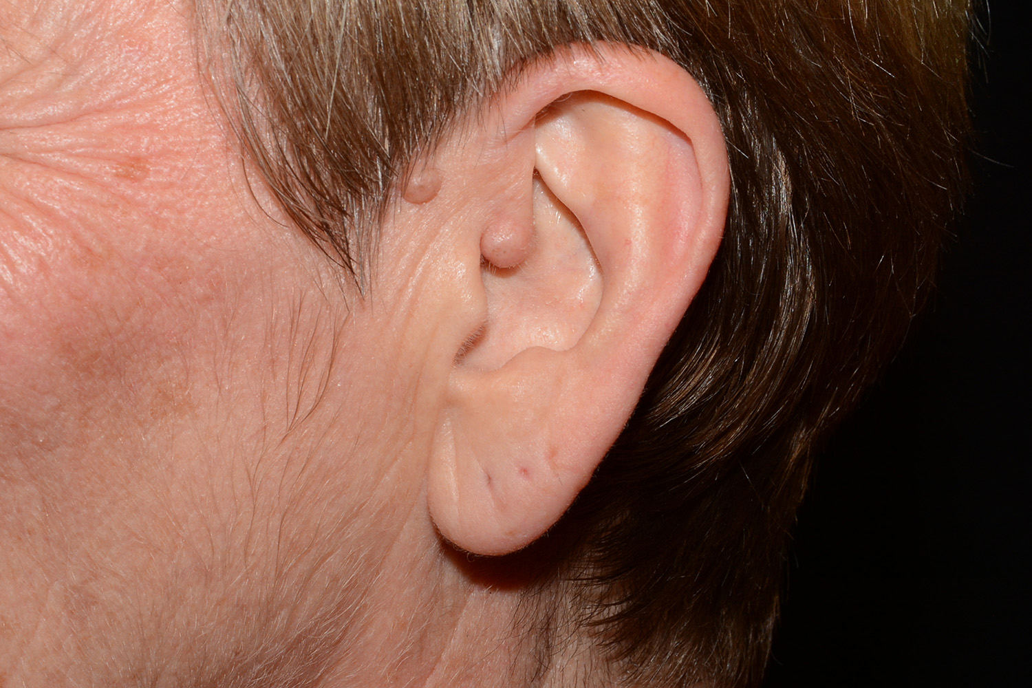 Before Image: Earlobe Reduction - left-side