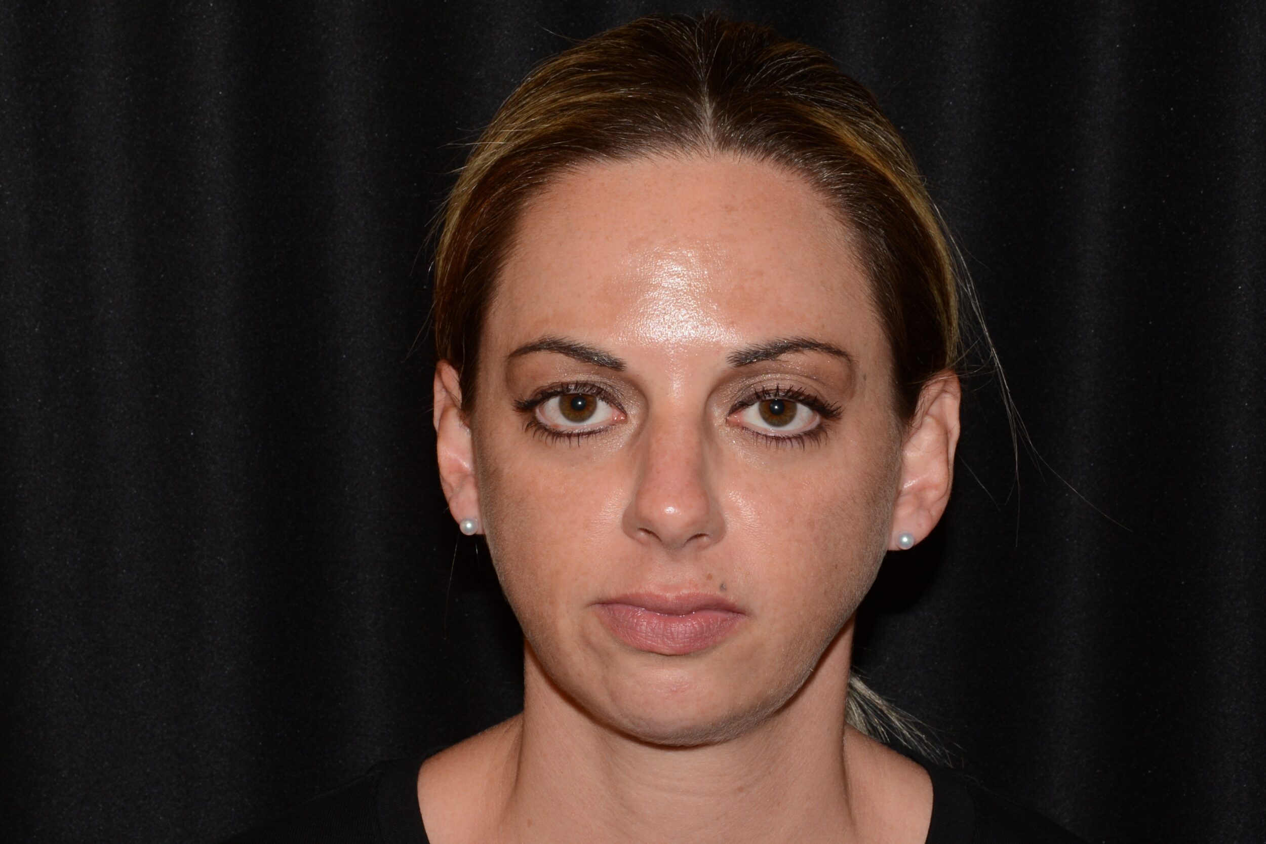 Before Image: Upper Face - front