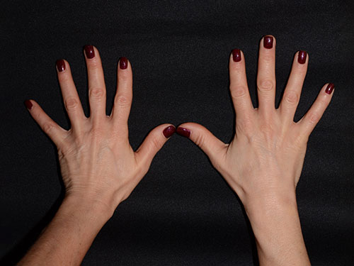 Before Image: Hand Rejuvenation - front