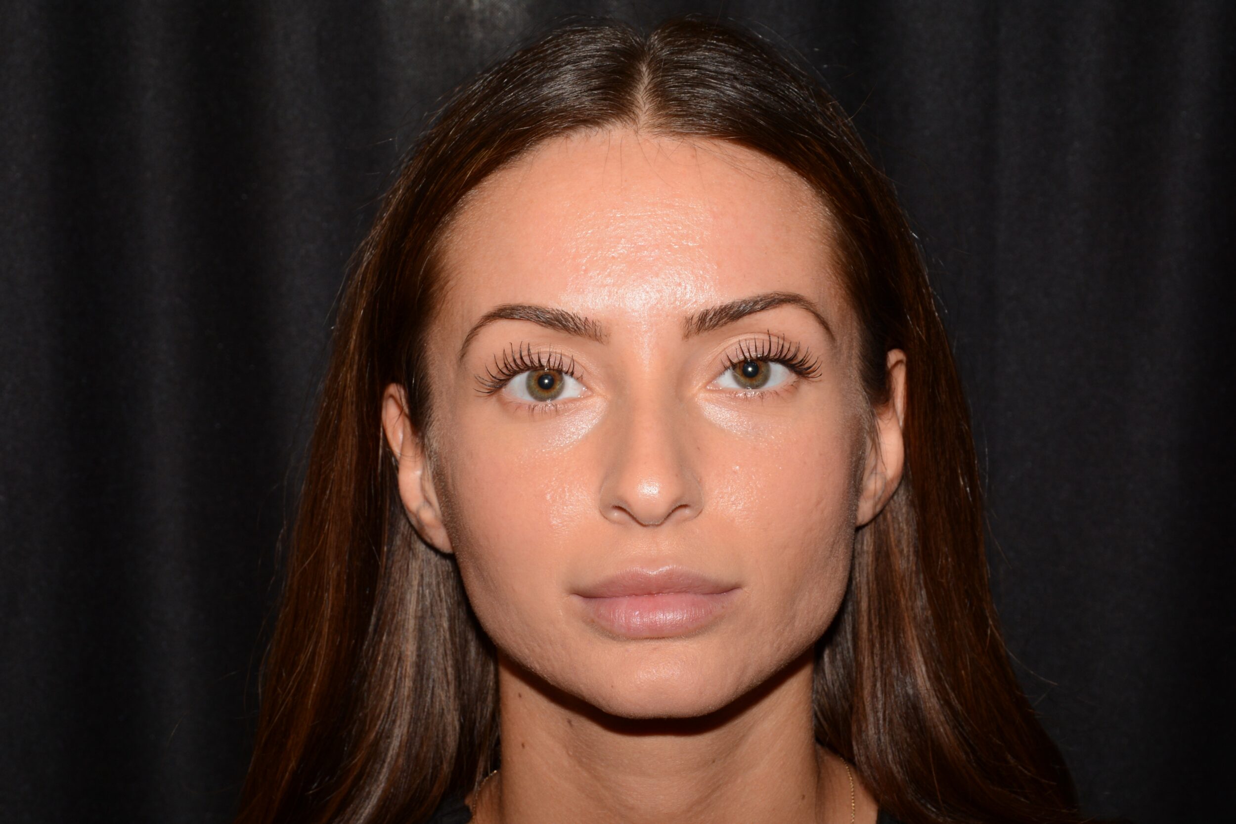 Before Image: Jaw Slimming - front