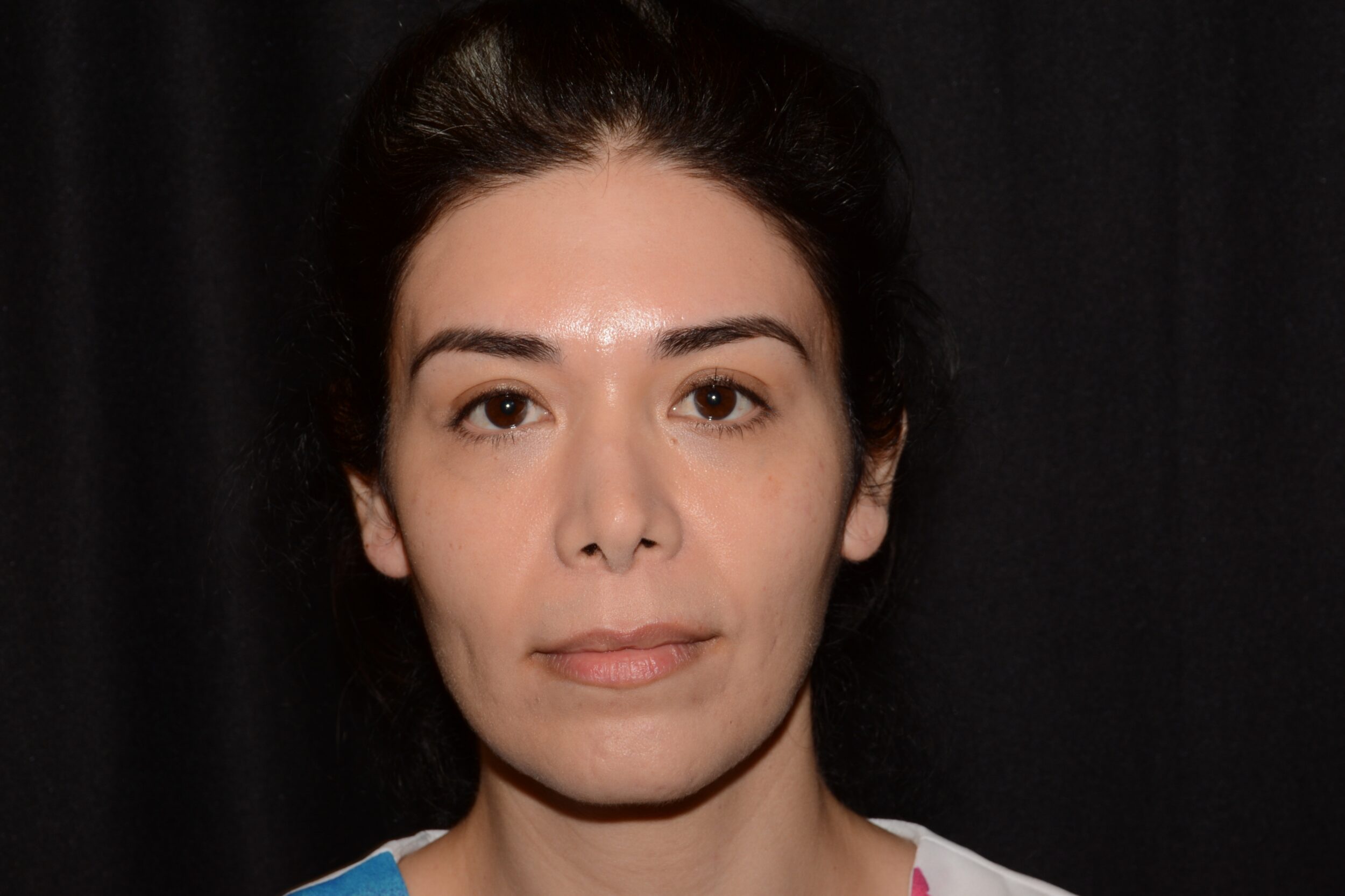 After Image: Jaw Slimming - front