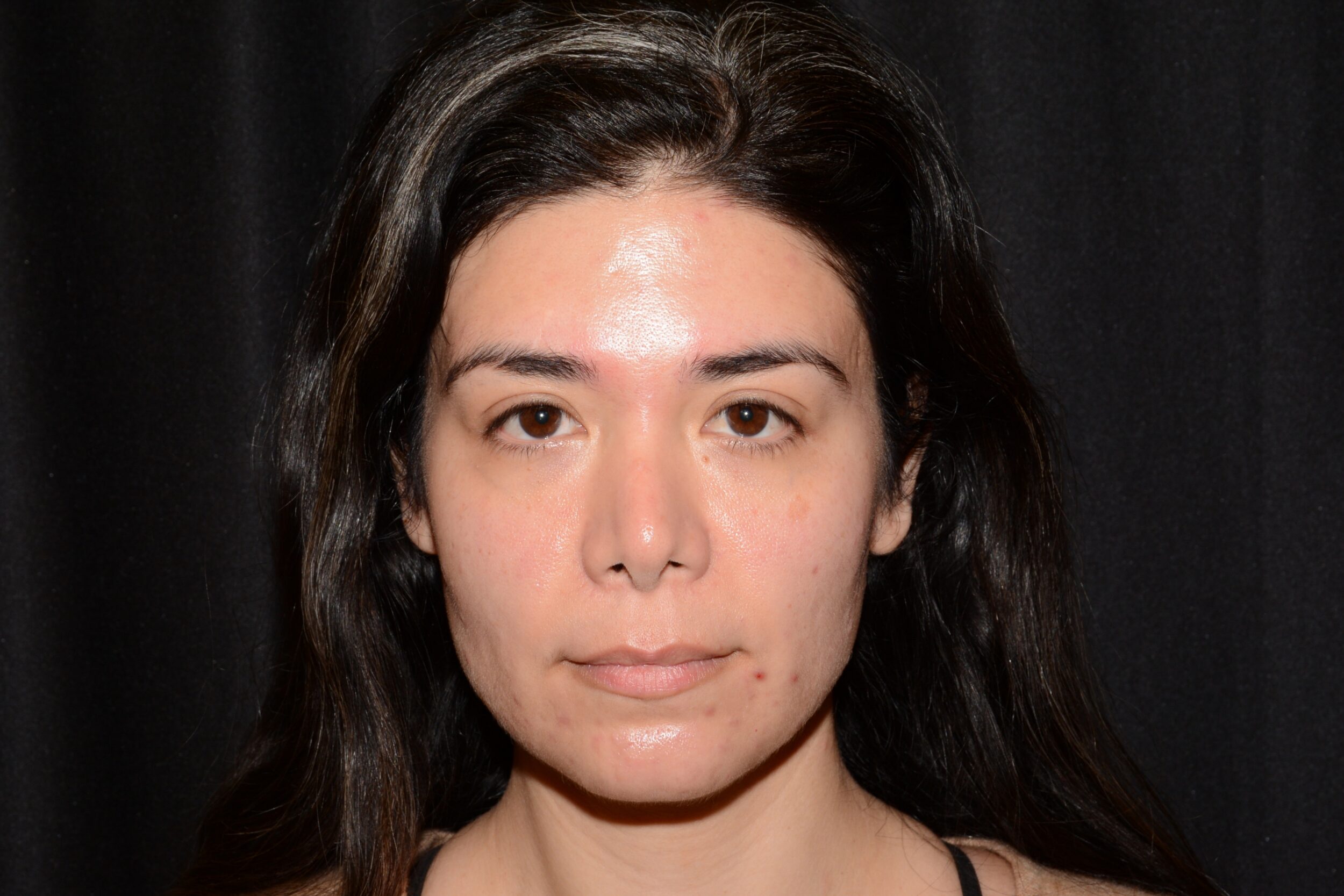 Before Image: Jaw Slimming - front