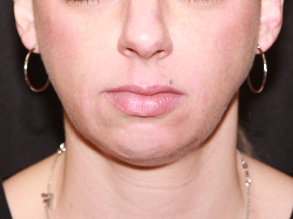 Before Image: Lip Filler - front