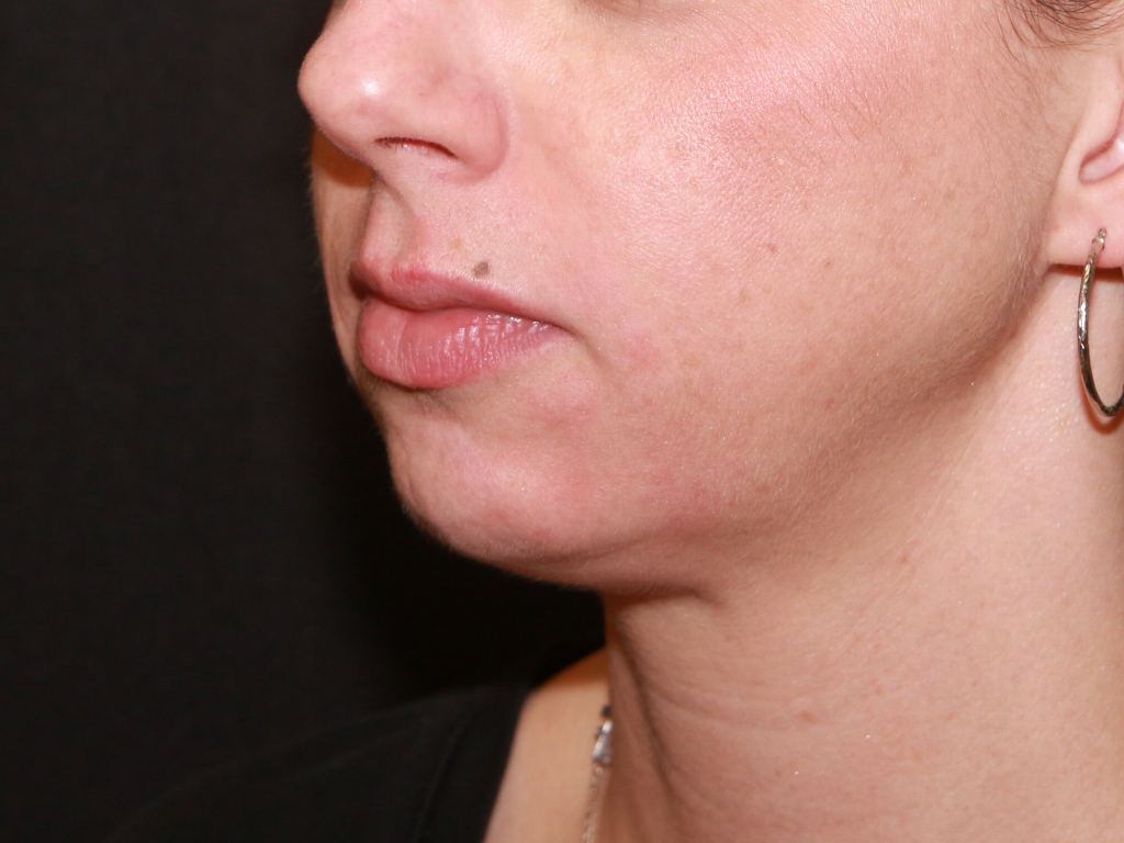Before Image: Lip Filler - left-front-oblique