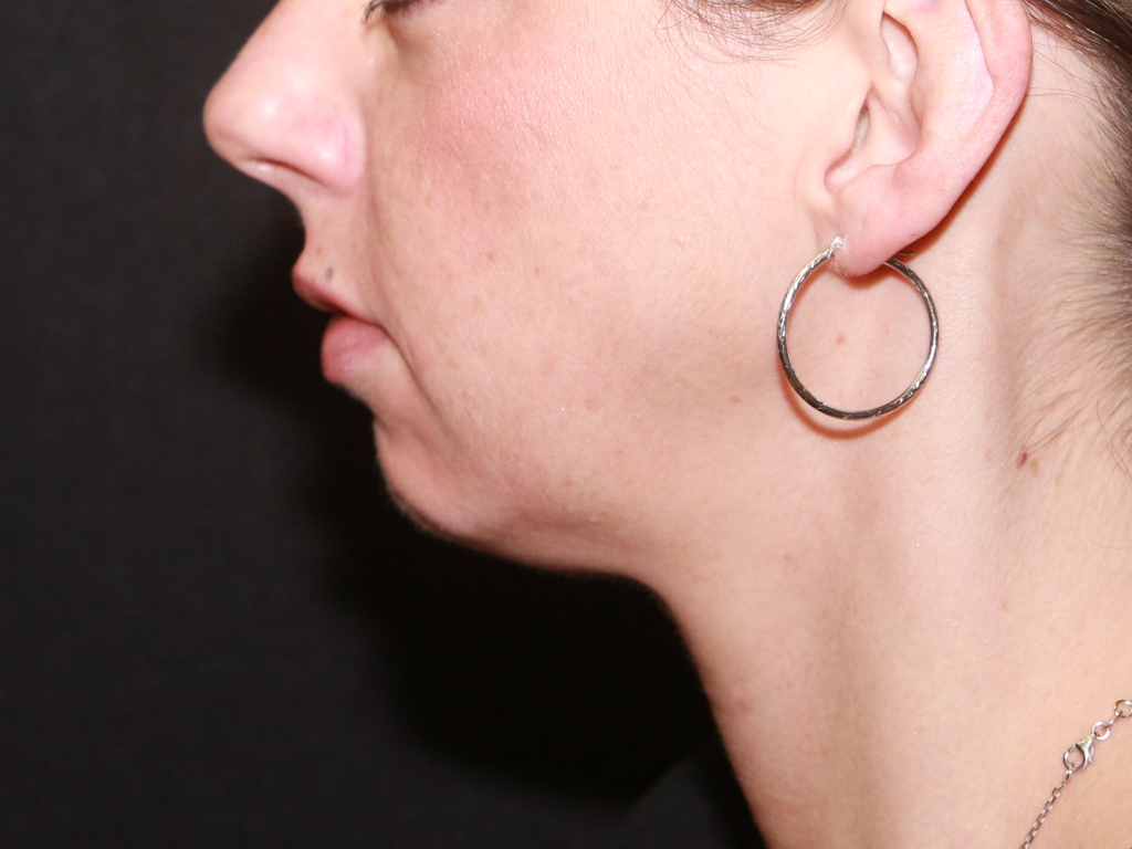 Before Image: Lip Filler - left-side