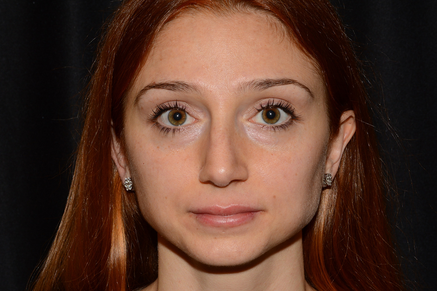 After Image: Lip Filler - front