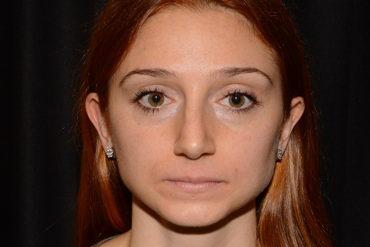 Before Image: Lip Filler - front