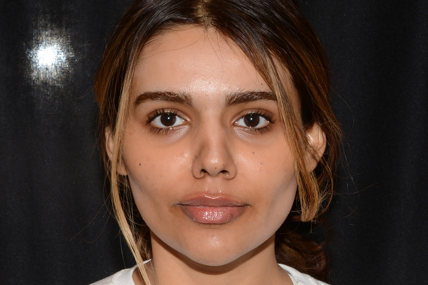 After Image: Lip Filler - front