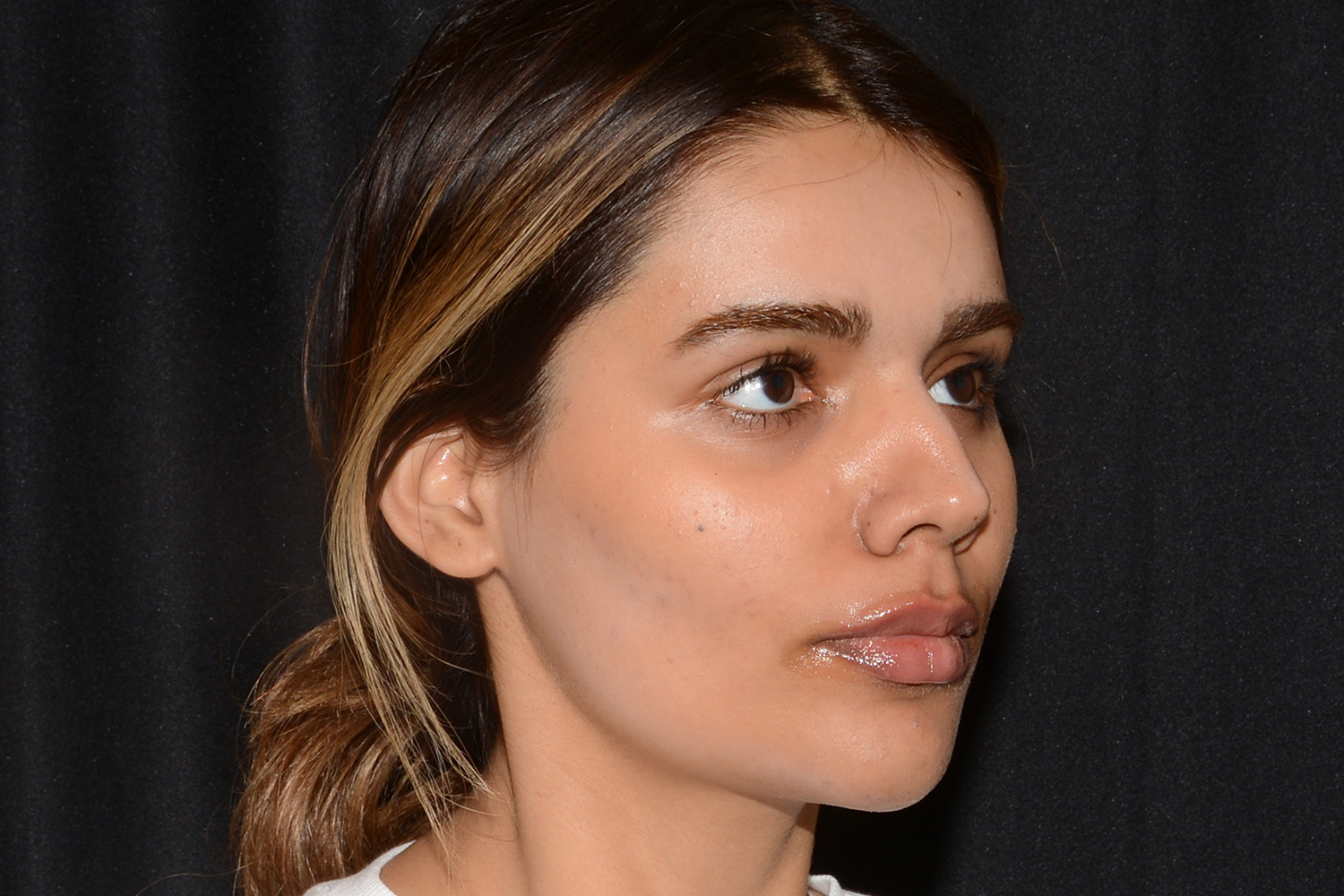 After Image: Lip Filler - right-front-oblique