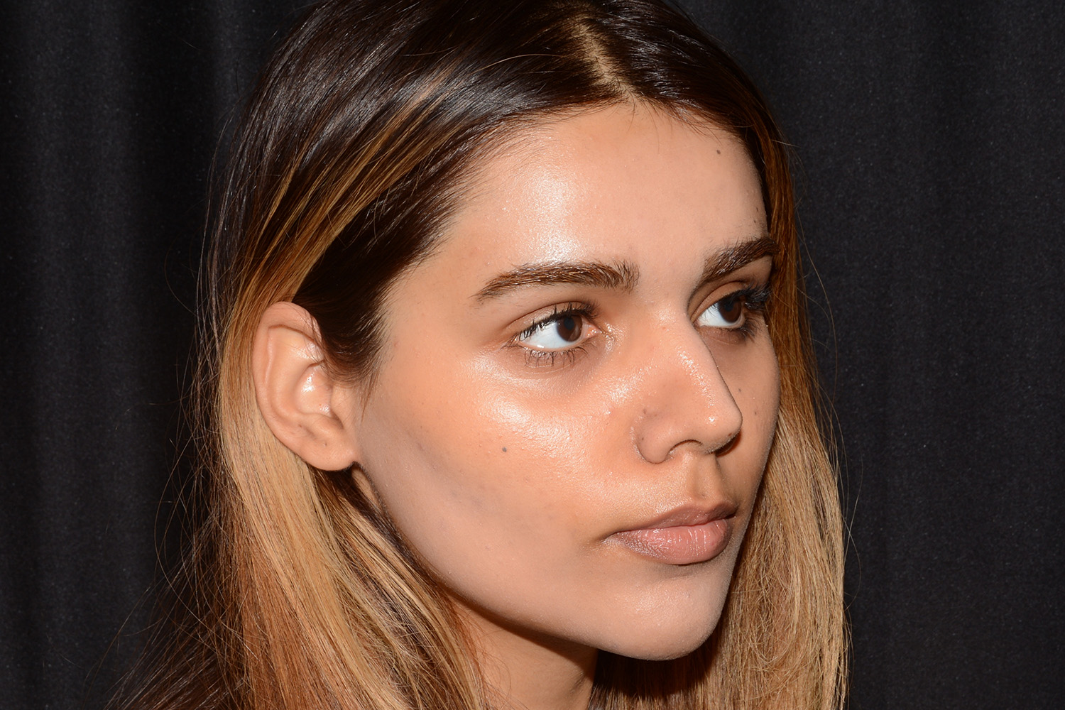 Before Image: Lip Filler - right-front-oblique