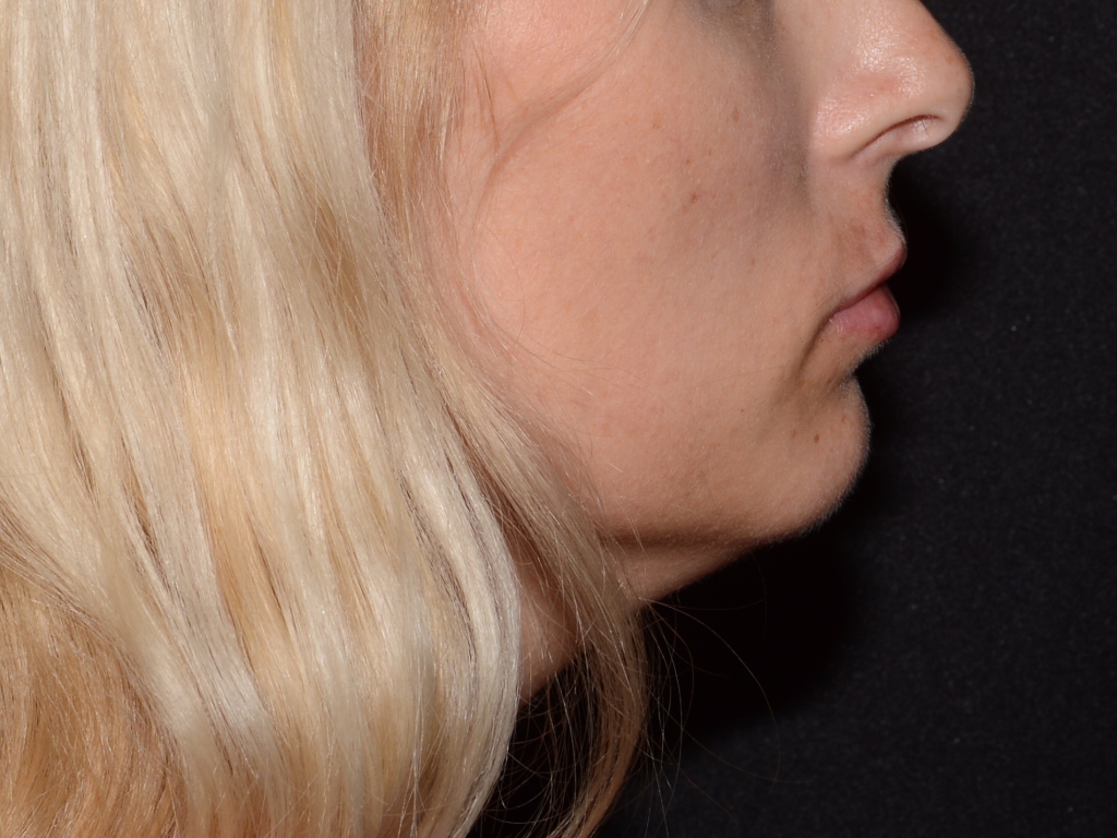 After Image: Lip Filler - right-side