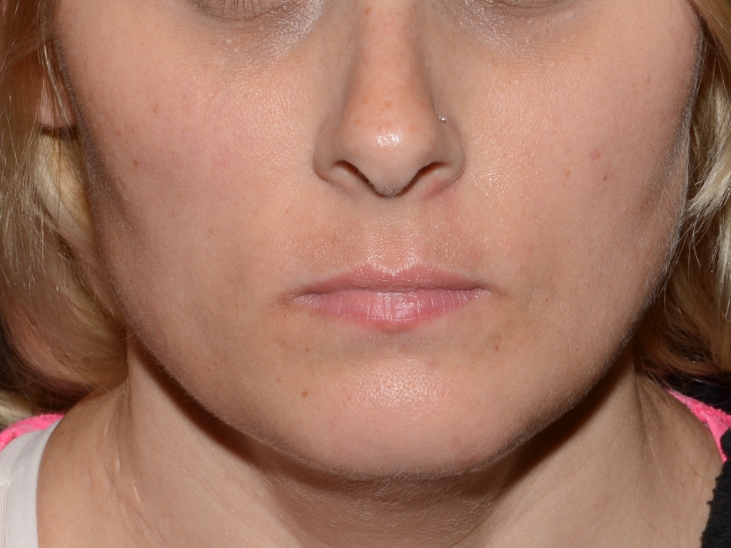Before Image: Lip Filler - front