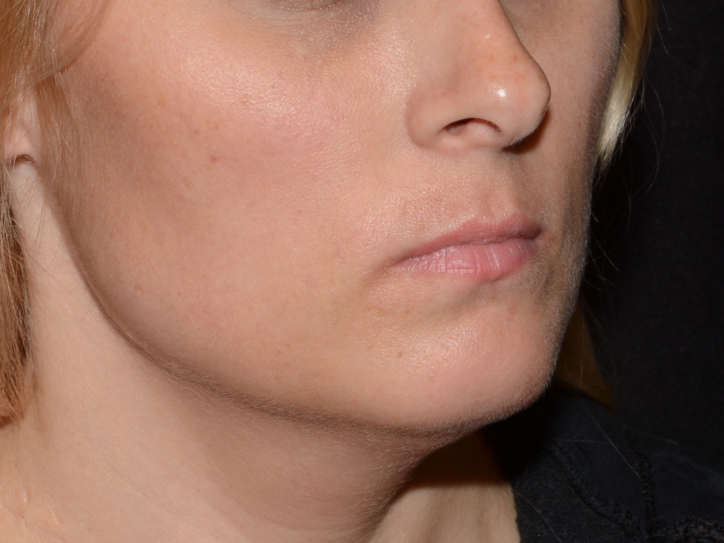 Before Image: Lip Filler - right-front-oblique