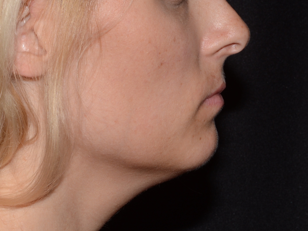 Before Image: Lip Filler - right-side