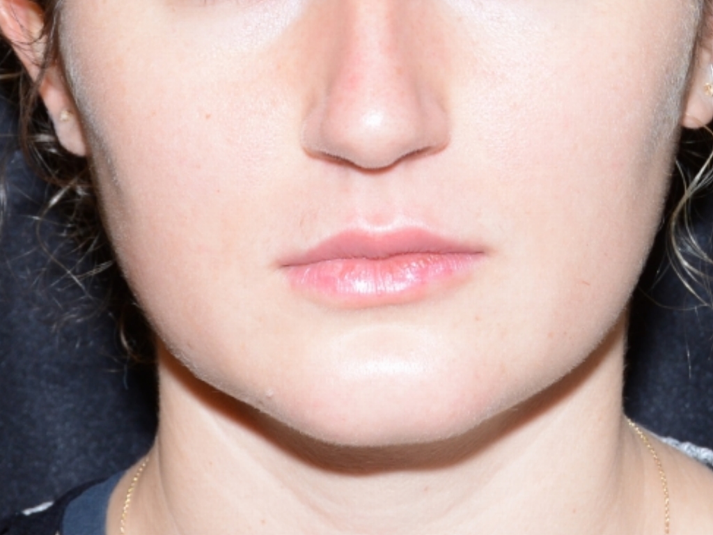 After Image: Lip Filler - front