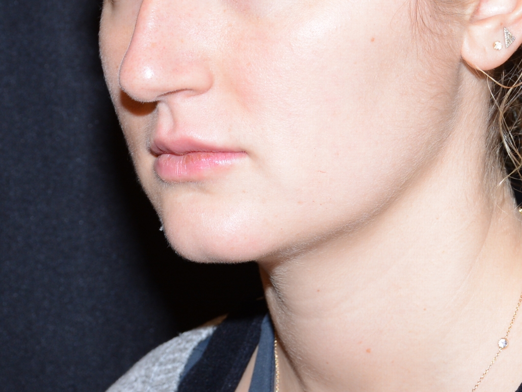 After Image: Lip Filler - left-front-oblique