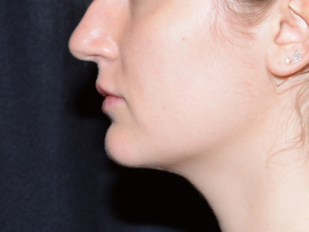 After Image: Lip Filler - left-side