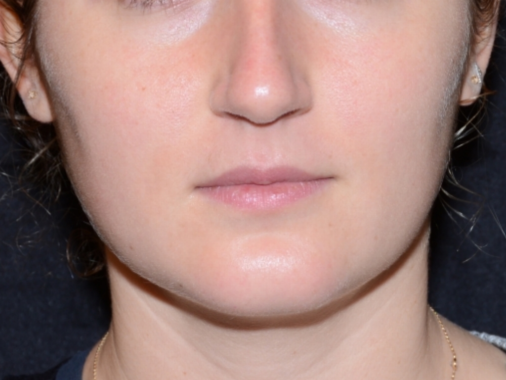 Before Image: Lip Filler - front