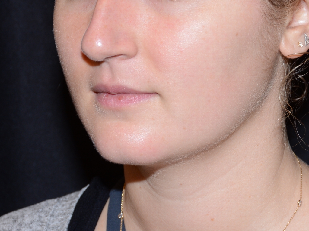 Before Image: Lip Filler - left-front-oblique