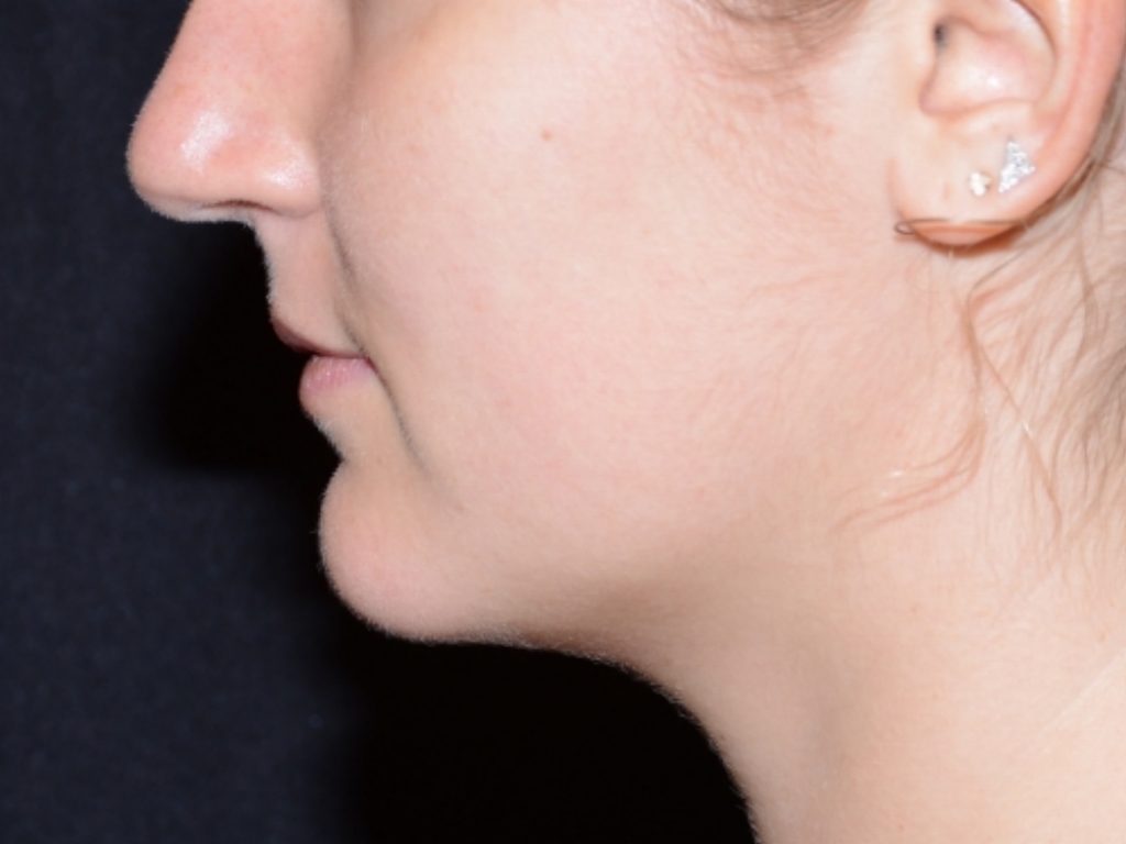 Before Image: Lip Filler - left-side