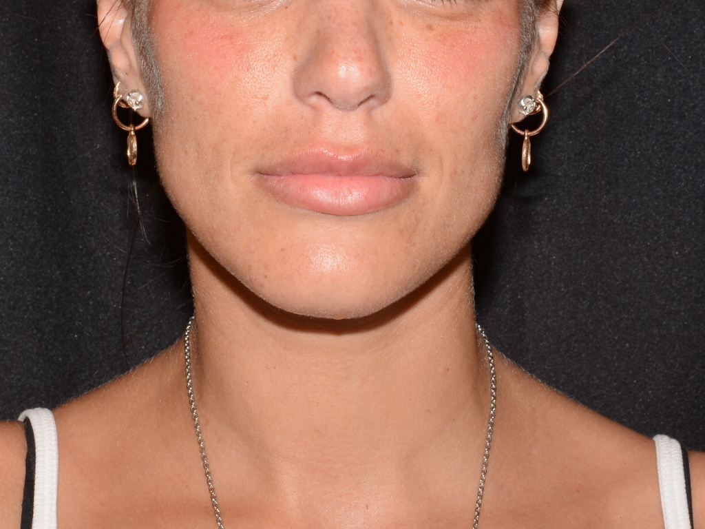 Before Image: Lip Filler - front