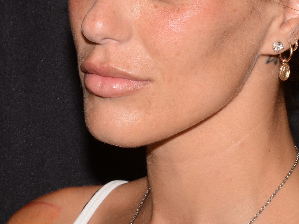 Before Image: Lip Filler - left-front-oblique