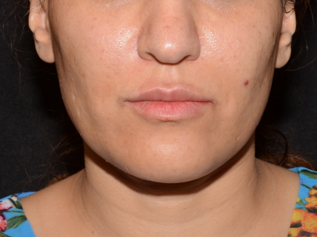 After Image: Lip Filler - front