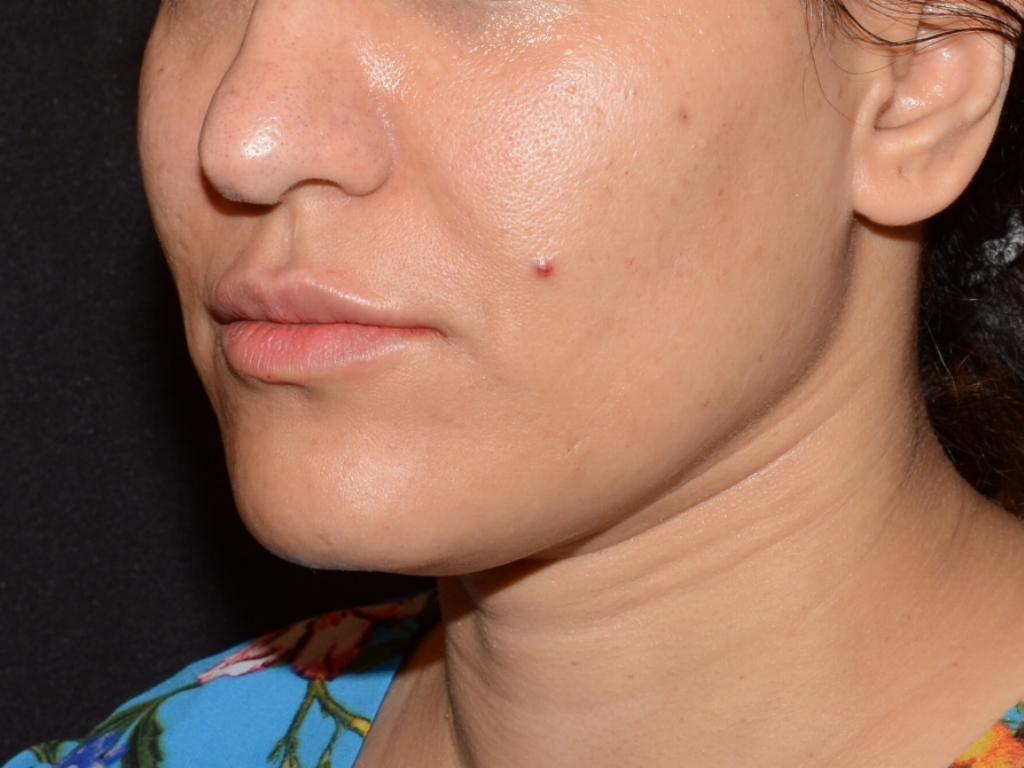 After Image: Lip Filler - left-front-oblique