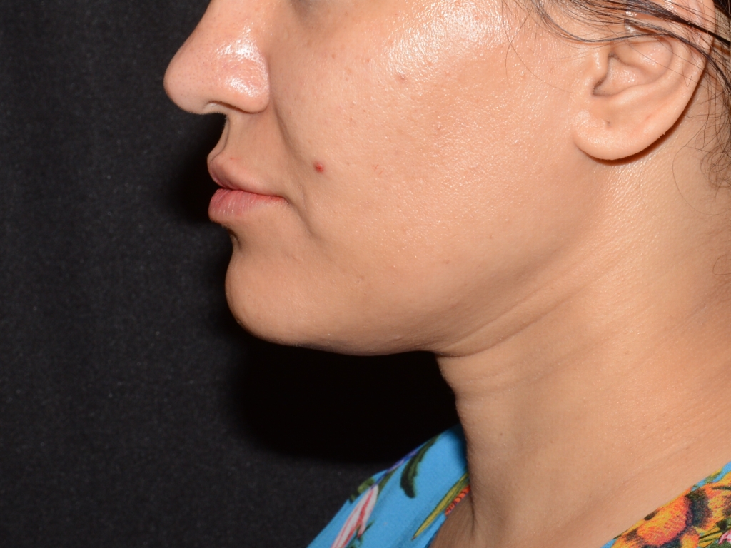 After Image: Lip Filler - left-side