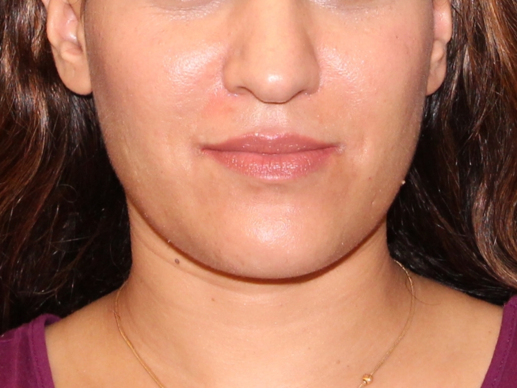 Before Image: Lip Filler - front