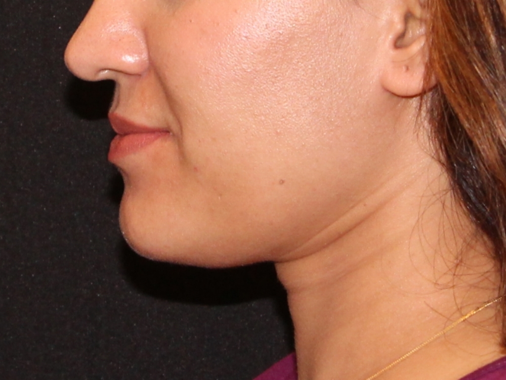 Before Image: Lip Filler - left-side