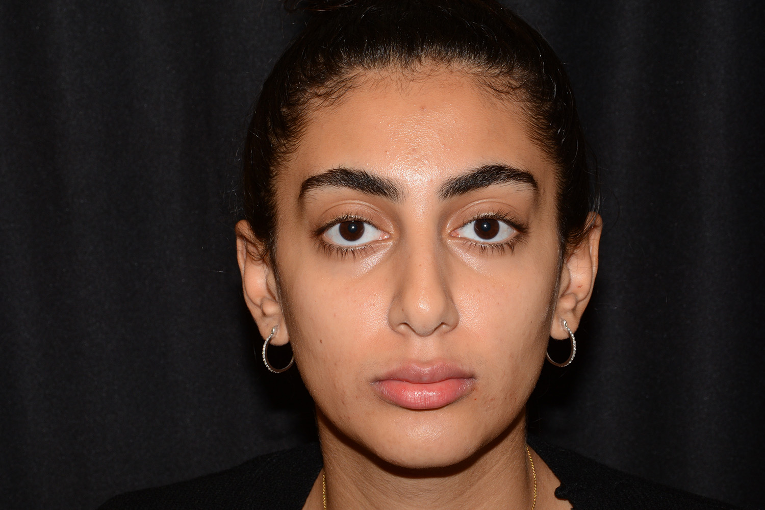 After Image: Lip Filler - front