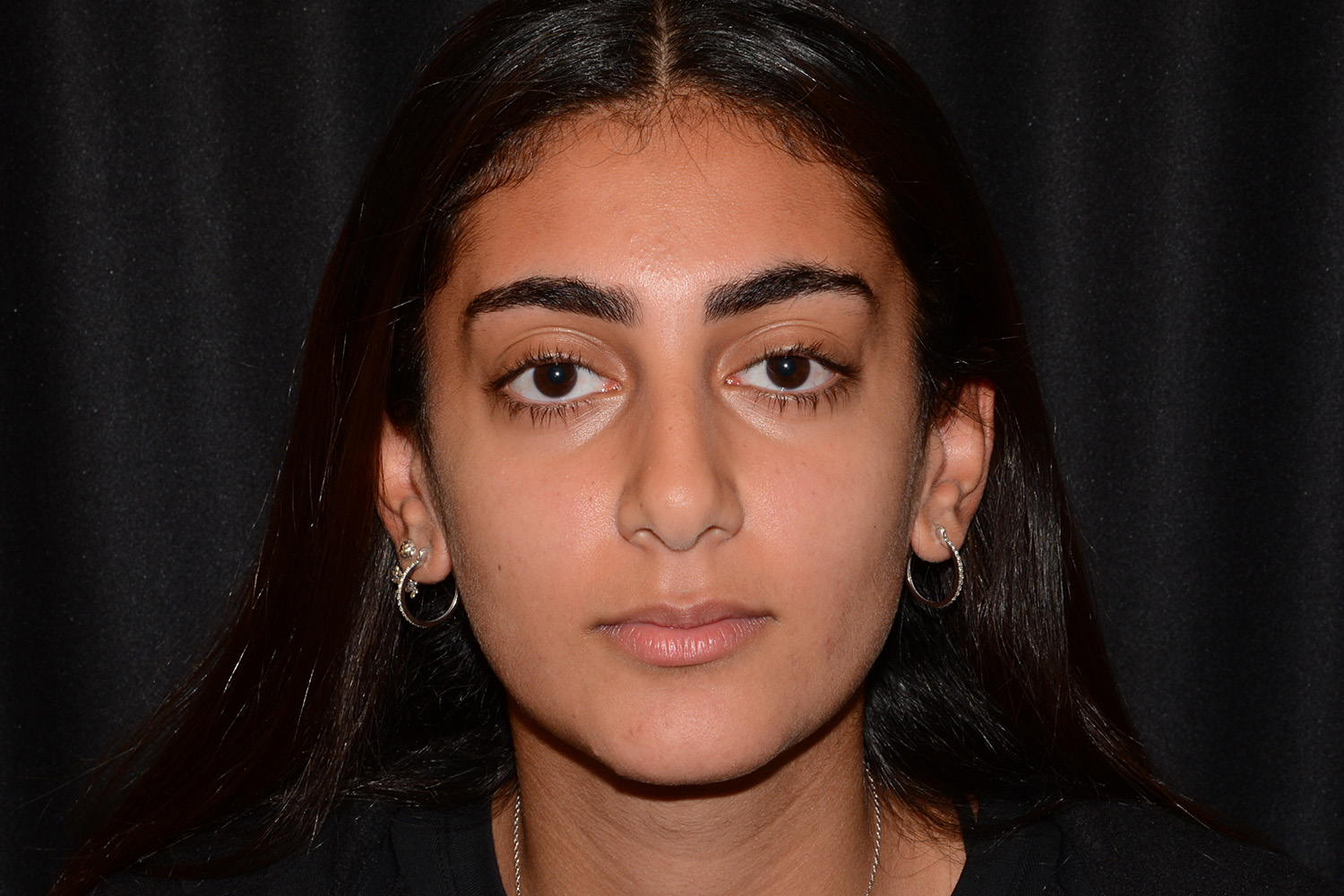 Before Image: Lip Filler - front