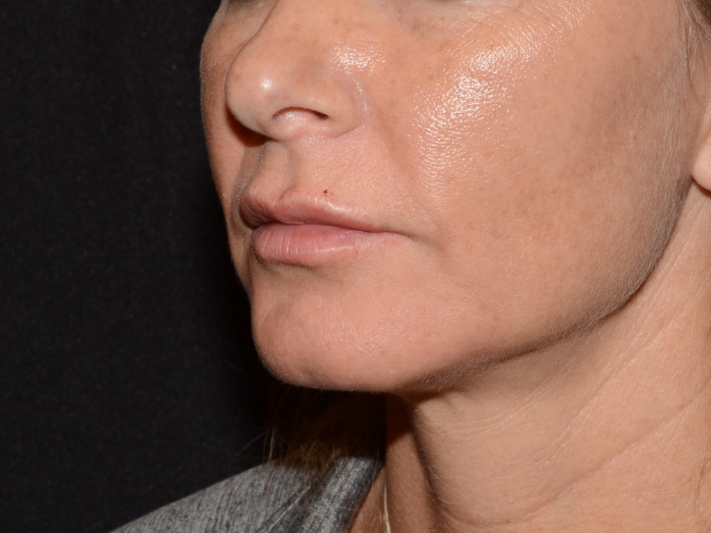 After Image: Lip Filler - left-front-oblique