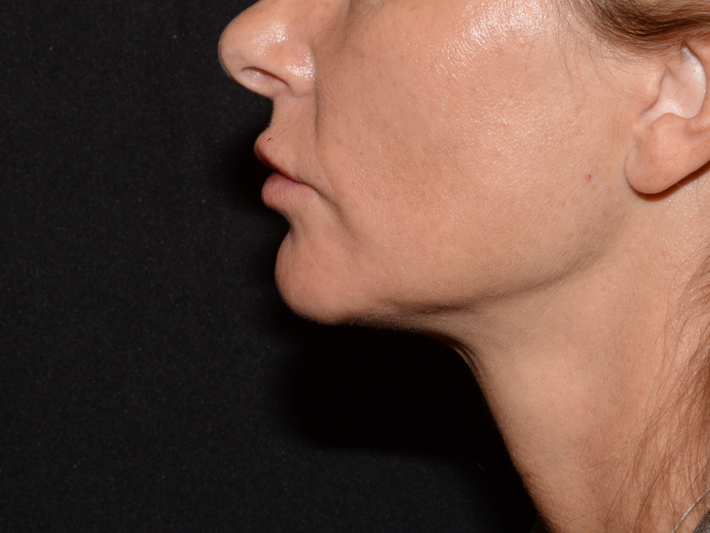 After Image: Lip Filler - left-side