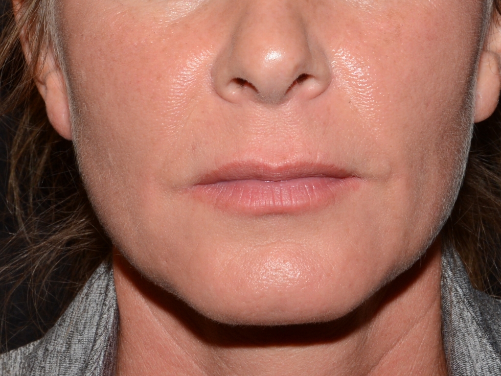 Before Image: Lip Filler - front