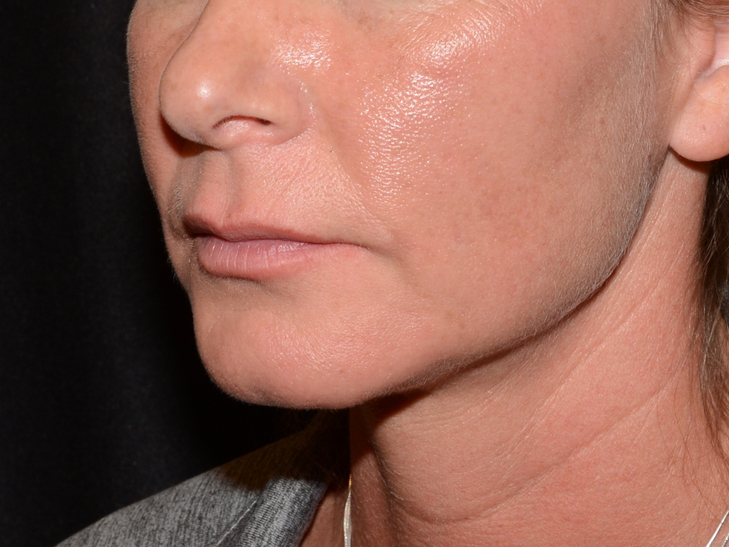Before Image: Lip Filler - left-front-oblique
